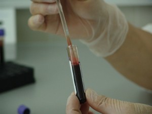 sida-vih-hiv-examen-sangre-transmision-sexual-clinica-enfermedad-prevencion-ingenieria-hospitalaria-equipos-medicos